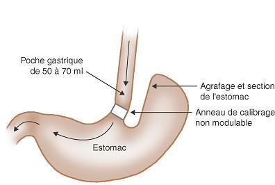 Picture of a calibrated vertical gastroplasty